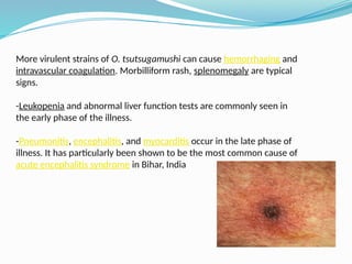 Morbilliform Rash Test Revisiting Scrub Typhus: Challenges and Advances in Diagnosis and ...