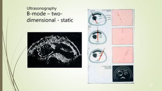 22
Ultrasonography
B-mode – two-
dimensional - static
 