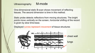 23
Ultrasonography M-mode
One-dimensional static B-scan shows movement of reflecting
tissues. The second dimension is time in this method.
Static probe detects reflections from moving structures. The bright
points move vertically on the screen, horizontal shifting of the record
is given by slow time-base.
Displayed curves represent movement of tissue structures
chest wall
lungs
 