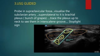 3.USG GUIDED
Probe in supraclavicular fossa...visualise the
subclavian artery ...superolateral to it is brachial
plexus ( bunch of grapes) ....trace the plexus up to
neck to see them in interscalene groove.... Stoplight
sign
 