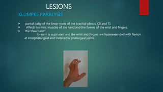 LESIONS
KLUMPKE PARALYSIS
 partial palsy of the lower roots of the brachial plexus. C8 and T1
 Affects intrinsic muscles of the hand and the flexors of the wrist and fingers.
 the“claw hand”
forearm is supinated and the wrist and fingers are hyperextended with flexion
at interphalangeal and metacarpo phalangeal joints.
 