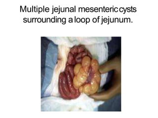 Multiple jejunal mesentericcysts
surrounding aloop of jejunum.
 
