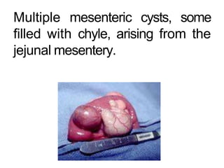 Multiple mesenteric cysts, some
filled with chyle, arising from the
jejunal mesentery.
 