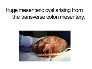 Hugemesenteric cyst arising from
the transverse colonmesentery.
 