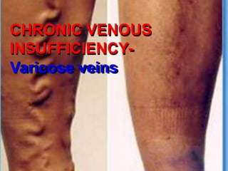 CHRONIC VENOUS
INSUFFICIENCY-
Varicose veins
 