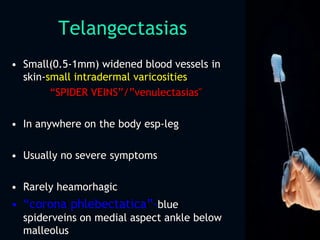 Telangectasias
• Small(0.5-1mm) widened blood vessels in
skin-small intradermal varicosities
“SPIDER VEINS”/”venulectasias"
• In anywhere on the body esp-leg
• Usually no severe symptoms
• Rarely heamorhagic
• “corona phlebectatica”-blue
spiderveins on medial aspect ankle below
malleolus
 