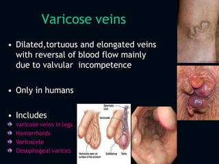 Varicose veins
• Dilated,tortuous and elongated veins
with reversal of blood flow mainly
due to valvular incompetence
• Only in humans
• Includes
varicose veins in legs
Hemorrhoids
Varicocele
Oesophageal varices
 
