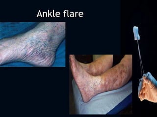 Ankle flare
 