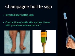 Champagne bottle sign
• Inverted beer bottle look
• Contraction of ankle skin and s/c tissue
with prominent edematous calf
 