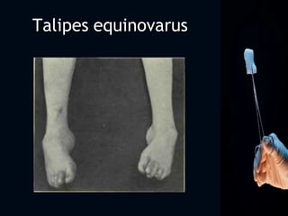 Talipes equinovarus
 