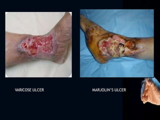 VARICOSE ULCER MARJOLIN’S ULCER
 