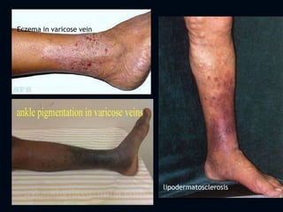 Eczema in varicose vein
lipodermatosclerosis
 