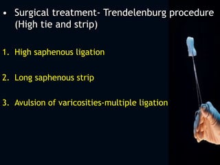 • Surgical treatment- Trendelenburg procedure
(High tie and strip)
1. High saphenous ligation
2. Long saphenous strip
3. Avulsion of varicosities-multiple ligation
 