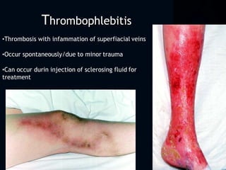 Thrombophlebitis
•Thrombosis with infammation of superfiacial veins
•Occur spontaneously/due to minor trauma
•Can occur durin injection of sclerosing fluid for
treatment
 