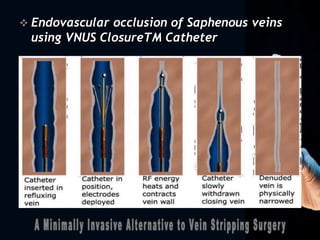  Endovascular occlusion of Saphenous veins
using VNUS ClosureTM Catheter
 