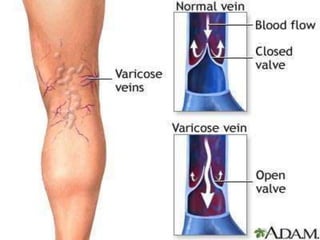 Telangectasias
• Small(0.5-1mm) widened blood vessels in
skin-small intradermal varicosities
“SPIDER VEINS”/”venulectasias...