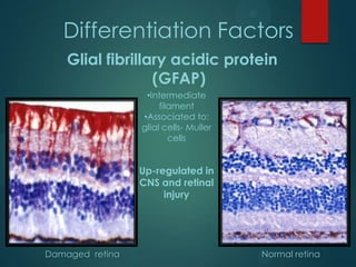 Differentiation Factors
Glial fibrillary acidic protein
(GFAP)
•Intermediate
filament
•Associated to:
glial cells- Muller
cells

Up-regulated in
CNS and retinal
injury

Damaged retina

Normal retina

 