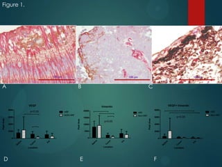 Figure 1.

*

100 μm

100 μm

A

B

C

VEGF
8000

VEGF+ Vimentin

Vimentin

p<0.05

8000

20000

HRF
NON-HRF

6000

HRF
Non-HRF

4000

p<0.05
10000

4000

E

Location

F

Iri
s

Tu
m

a
et
in
R

Tu
m

et
in
R

Tu
m

et
in
R

Iri
s

Location

Location

or

0
Iri
s

0

or

0

a

2000

or

5000

a

2000

D

HRF
Non-HRF

p<0.05

6000

Pixel Area

15000

Pixel Area

Pixel Area

100 μm

 