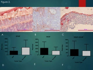Figure 2.

*

*

100 μm

A

B

GFAP

C
VEGF

VEGF+GFAP

4000

800

2000
1000
0

F

R
F
H

on
-H

H

on
-H

R

R
F

R

N

N

E

N

R
F
H

0

Tumor Type

Tumor Type

D

400
200

F

0

F

1000

600

R

2000

3000

on
-H

3000

Pixel Area

1000

Pixel Area

5000

4000

Pixel Area

5000

Tumor Type

F

 