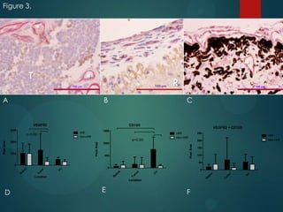 Figure 3.

*
*
*

T

*

*
100 μm

A

B

C

VEGFR2

CD105

3000

VEGFR2 + CD105

1500

HRF
Non-HRF

p<0.05

1000

HRF
Non-HRF

200

1000

Pixel Area

2000

250

HRF
Non-HRF

p<0.05
Pixel Area

Pixel Area

R

500

150
100
50

0

Location

D

E

F

Iri
s

Tu
m
or

R

et
in

a

Iri
s

Tu
m

et
in
R

Location

or

0

a

Iri
s

Tu
m
or

R

et
in

a

0

 