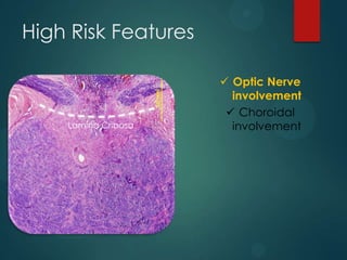 High Risk Features

Lamina Cribosa
Lamina Cribosa

 Optic Nerve
involvement
 Choroidal
involvement

 