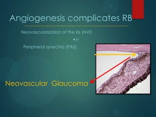 Angiogenesis complicates RB
Neovascularization of the iris (NVI)
+/Peripheral synechia (PAS)

Neovascular Glaucoma

 