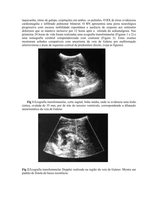 taquicardia, ritmo de galope, crepitações em ambos os pulmões. O RX de tórax evidenciou 
cardiomegalia e infiltrado pulmonar bilateral. O RN apresentou uma piora neurológica 
progressiva com escassa mobilidade espontânea e ausência de resposta aos estímulos 
dolorosos que se manteve inclusive por 12 horas após a retirada da sedoanalgesia. Nas 
primeiras 24 horas de vida foram realizadas uma ecografia transfontanelar (Figuras 1 e 2) e 
uma tomografia cerebral computadorizada com contraste (Figura 3). Estes exames 
mostraram achados compatíveis com aneurisma da veia de Galeno por malformação 
arteriovenosa e áreas de isquemia cortical de predomínio direito. (veja as figuras). 
Fig 1.Ecografia transfontanelar, corte sagital, linha média, onde se evidencia uma lesão 
cística, ovalada de 35 mm, por de trás do terceiro ventrículo, correspondendo a dilatação 
aneurismática da veia de Galeno 
Fig 2.Ecografia transfontanelar Doppler realizada na região da veia de Galeno. Mostra um 
padrão de fístula de baixa resistência. 
 