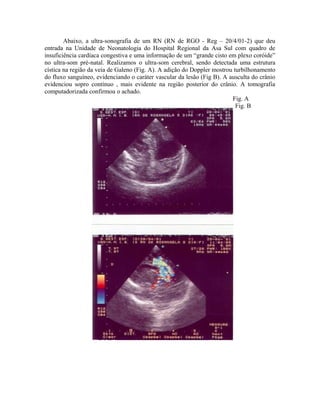 Abaixo, a ultra-sonografia de um RN (RN de RGO - Reg – 20/4/01-2) que deu 
entrada na Unidade de Neonatologia do Hospital Regional da Asa Sul com quadro de 
insuficiência cardíaca congestiva e uma informação de um “grande cisto em plexo coróide” 
no ultra-som pré-natal. Realizamos o ultra-som cerebral, sendo detectada uma estrutura 
cística na região da veia de Galeno (Fig. A). A adição do Doppler mostrou turbilhonamento 
do fluxo sanguíneo, evidenciando o caráter vascular da lesão (Fig B). A ausculta do crânio 
evidenciou sopro contínuo , mais evidente na região posterior do crânio. A tomografia 
computadorizada confirmou o achado. 
Fig. A 
Fig. B 
 