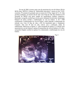No ano de 2003, tivemos outro caso de aneurisma da veia de Galeno: RN de 
MCM, Reg. 300785-2, Gêmeo B, “hidrocefalia intra-útero”; nasceu no dia 7/2/03, 
cesariana, 38 semanas de gestação; peso ao nascer de 2155g; Apgar de 9 e 10. Alta 
em boas condições, no terceiro dia de vida. Com 9 dias de vida, deu entrada na UTI 
Neonatal do HRAS com grave quadro de insuficiência cardíaca congestiva. 
Realizada a ecografia cerebral que revelou grave dilatação biventricular, hemorragia 
bilateral em plexo coróide e malformação na veia de Galeno. A TC e RM 
confirmaram a malformação da veia de Galeno, sendo indicada a embolização da 
referida veia. Com 23 dias de vida, o RN foi transferido para o Alojamento 
Conjunto. Alta com 38 dias de vida, estável, sem a realização, ainda, da 
embolização. Observem as figuras: C: ultra-sonografia do gêmeo A, à direita (sem 
aneurisma da veia de Galeno) e gêmeo B (aneurisma da veia de Galeno) e D: ultra-sonografia 
Doppler cerebral no gêmeo B, evidenciando a malformação da veia de 
Galeno. 
Fig. C 
 