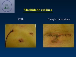 Morbidade cutânea Cirurgia convencional VEIL 