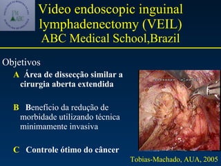 Video endoscopic inguinal lymphadenectomy (VEIL) ABC Medical School,Brazil Objetivos  A   Área de dissecção similar a cirurgia aberta extendida B   B enefício da redução de morbidade utilizando técnica minimamente invasiva C   Controle ótimo do câncer   Tobias-Machado, AUA, 2005 