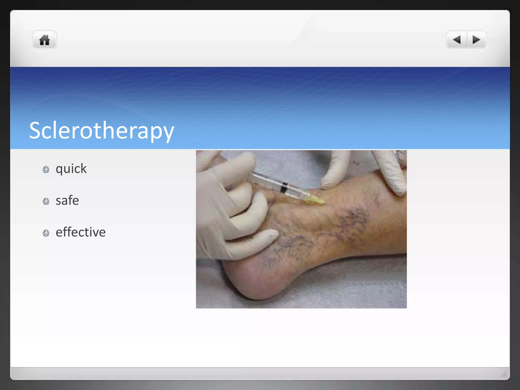 Sclerotherapy
quick
safe
effective