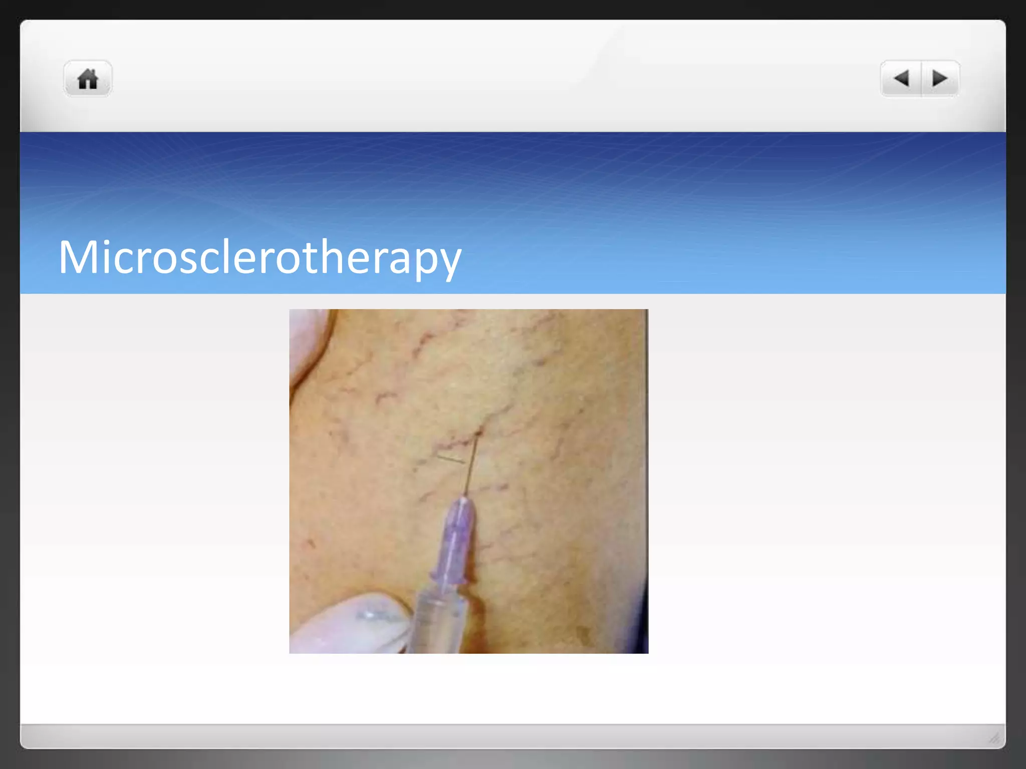 Microsclerotherapy