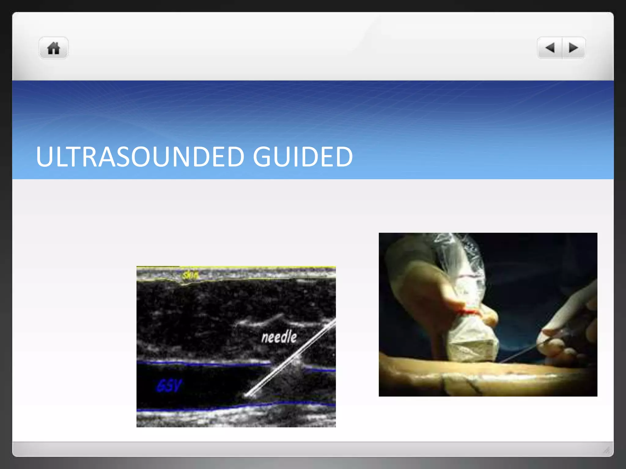 ULTRASOUNDED GUIDED