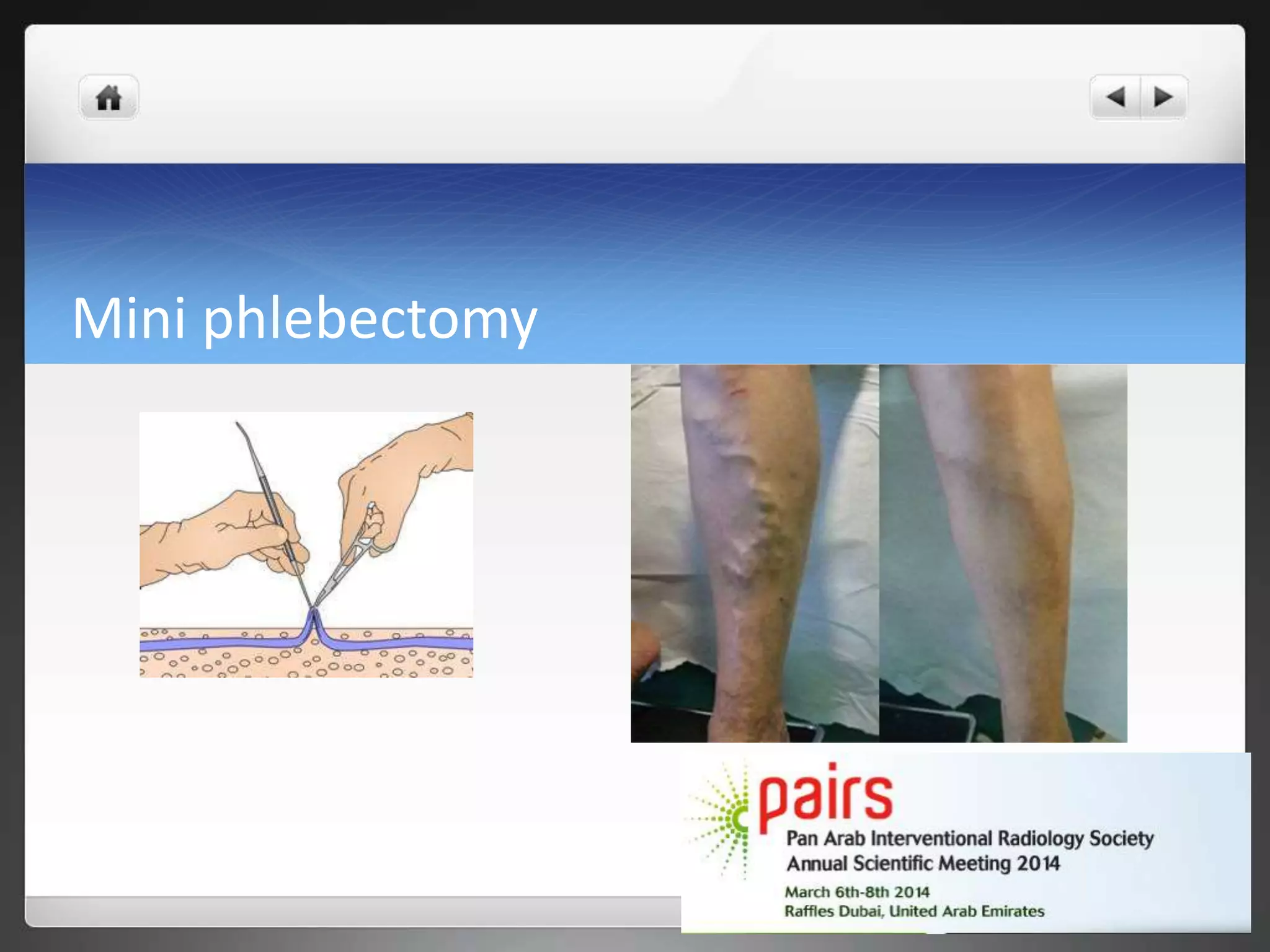 Mini phlebectomy
