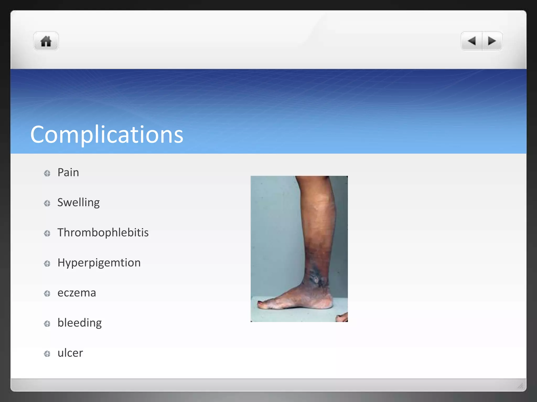 Complications
Pain
Swelling
Thrombophlebitis
Hyperpigemtion
eczema
bleeding
ulcer