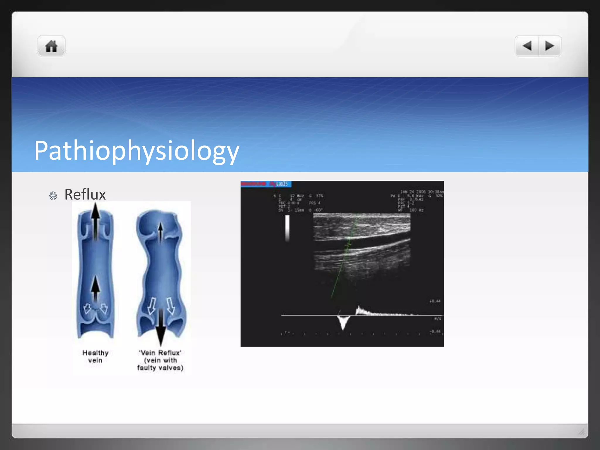 Pathiophysiology
Reflux