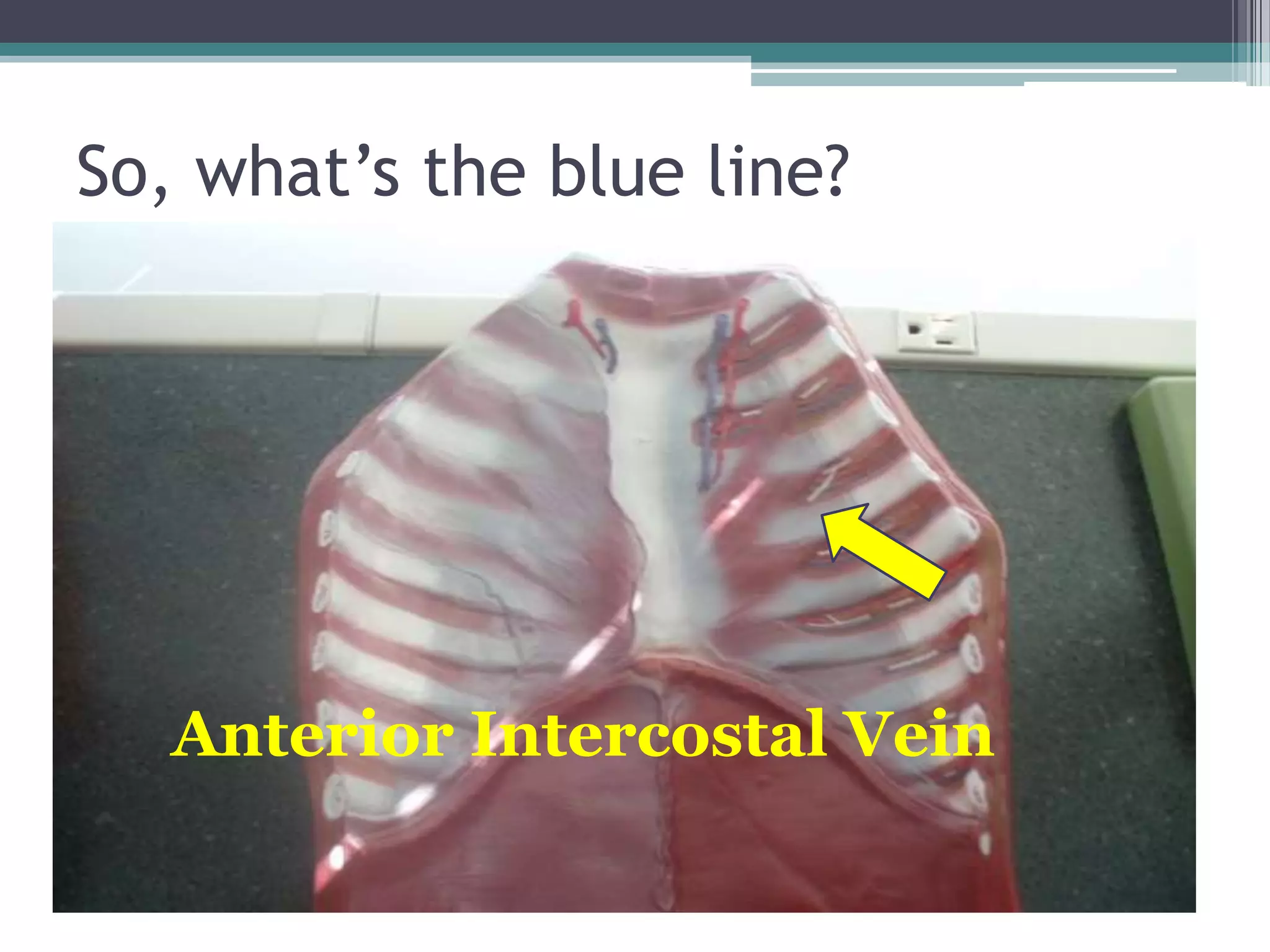 So, what’s the blue line?Anterior Intercostal Vein