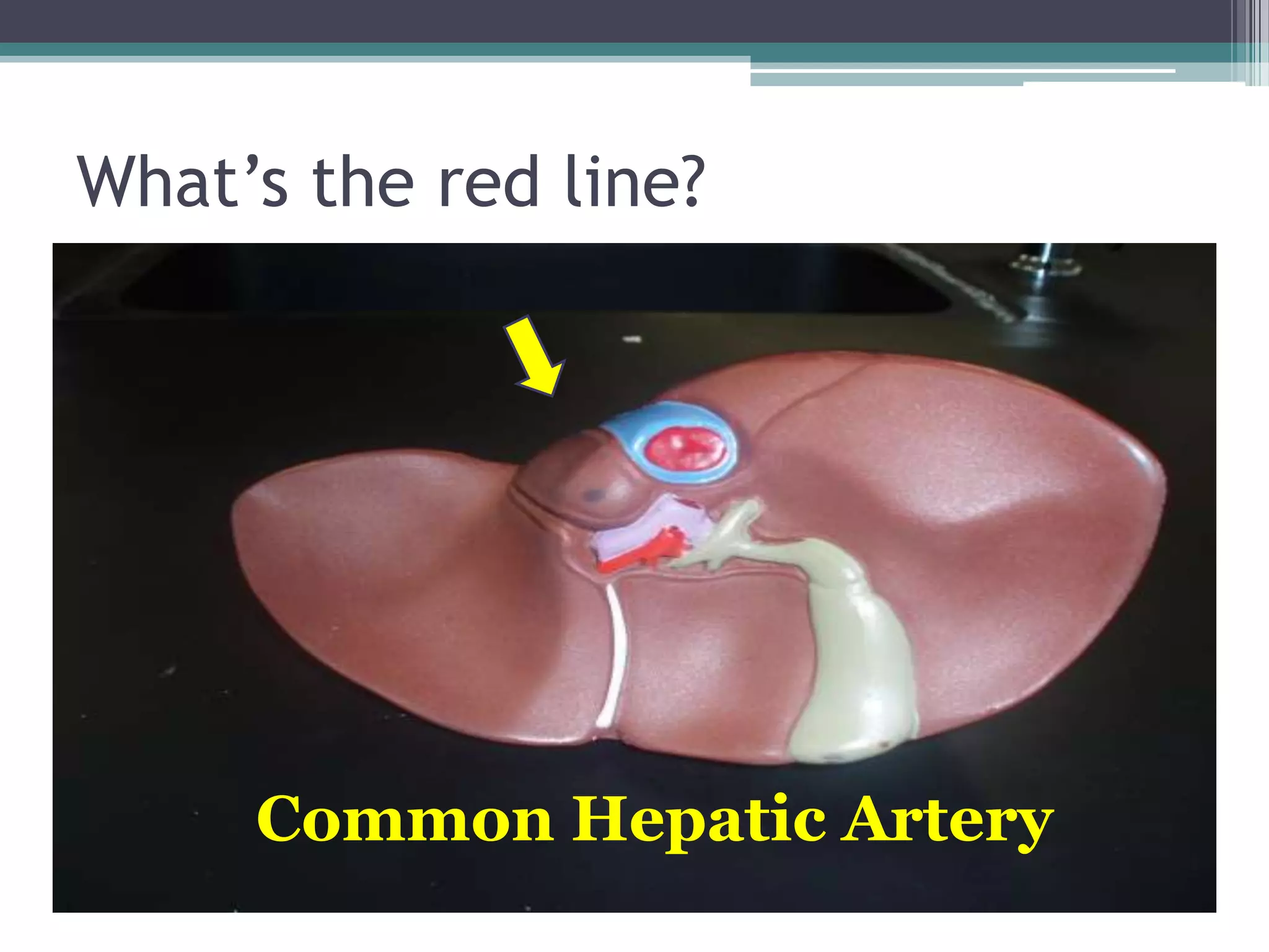 What’s the red line?Common Hepatic Artery