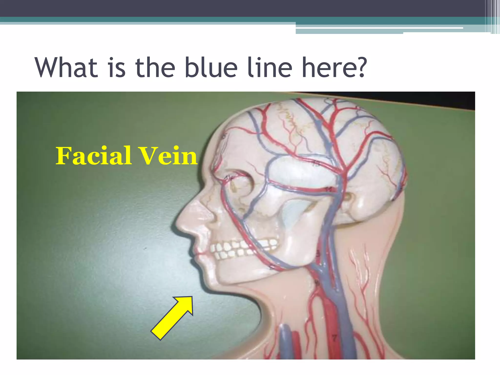 What is the blue line here?Facial Vein