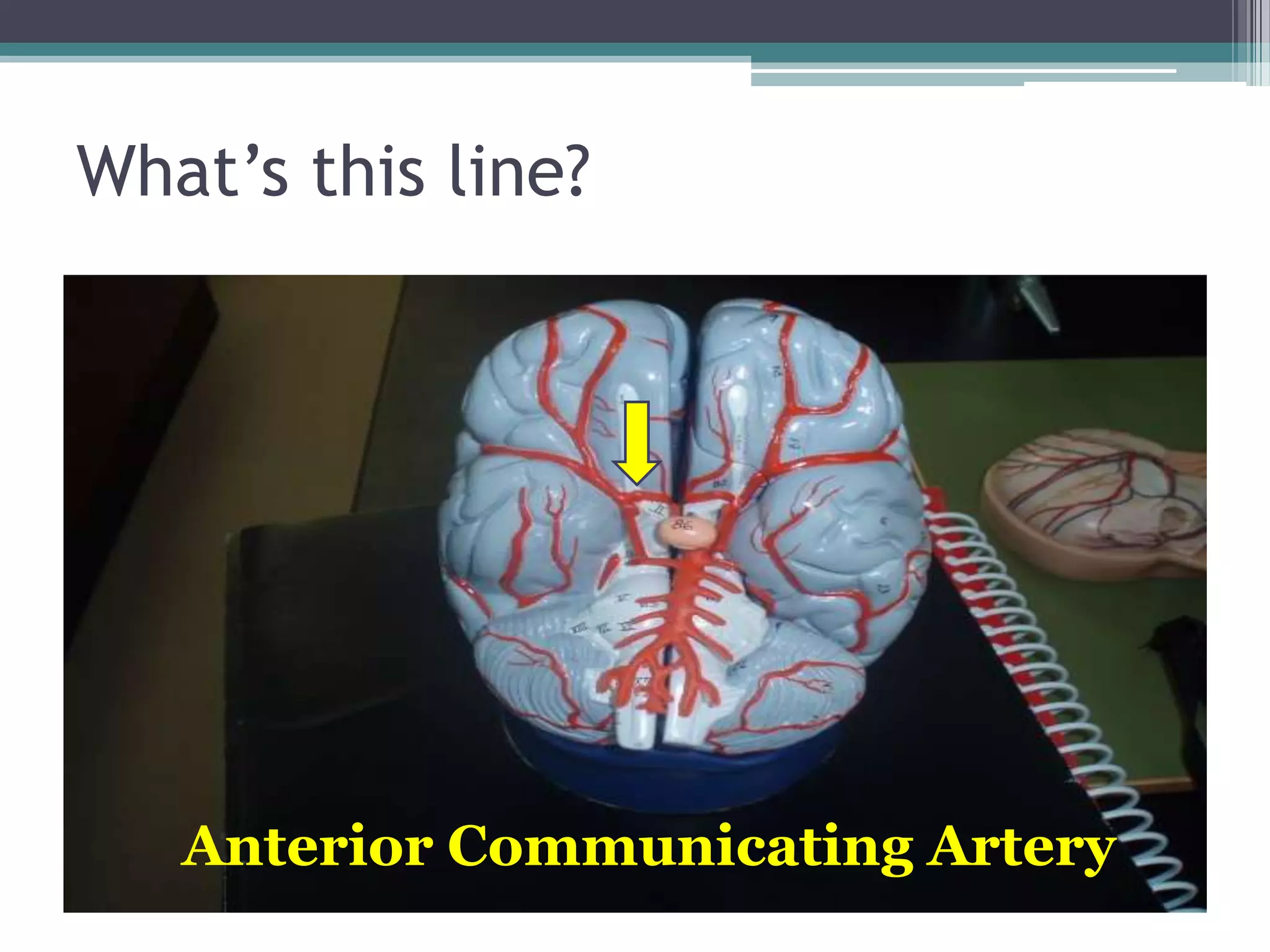 What’s this line?Anterior Communicating Artery