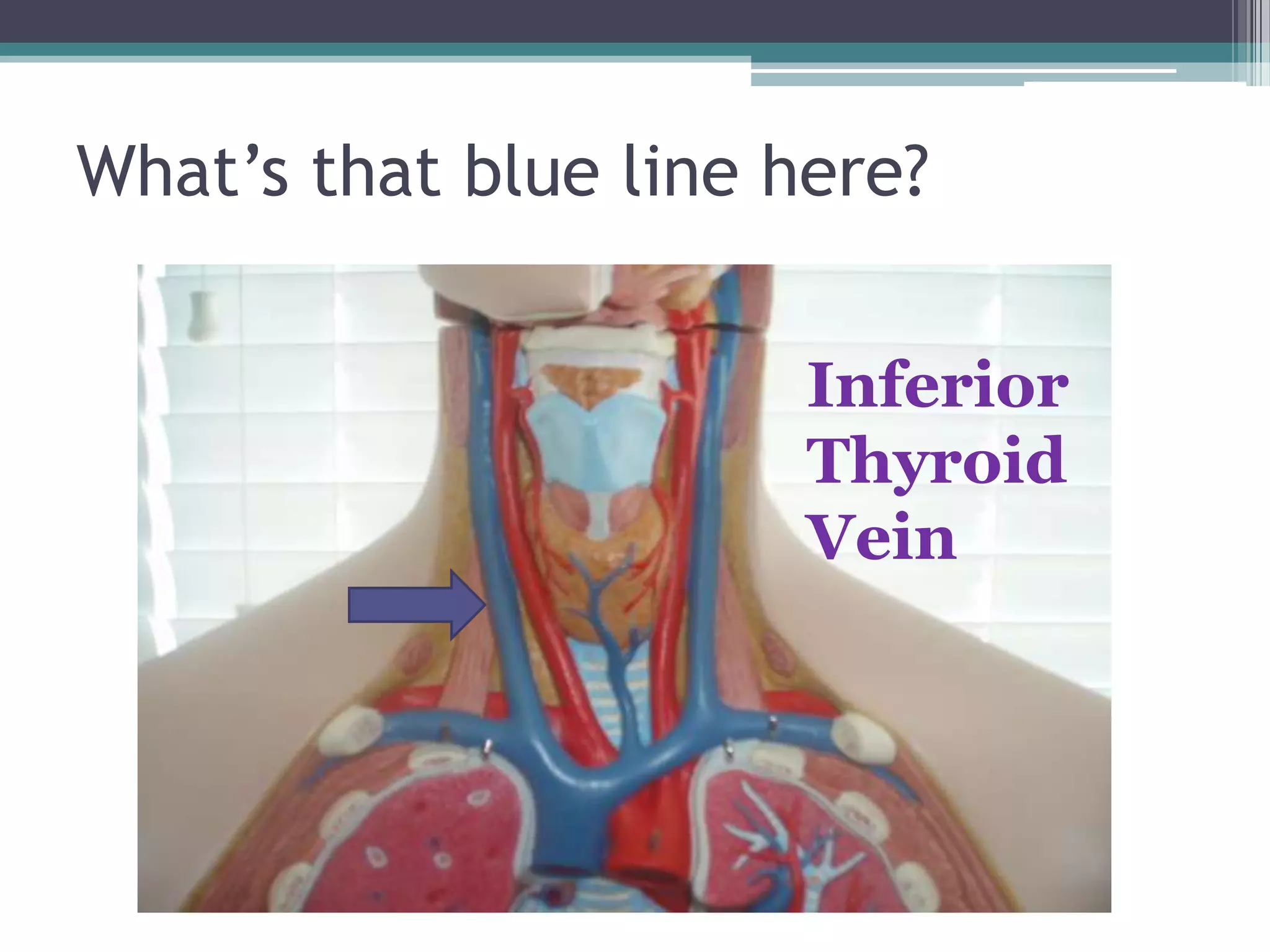 What’s that blue line here?Inferior Thyroid Vein