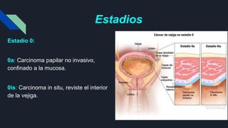 Estadios
Estadio 0:
0a: Carcinoma papilar no invasivo,
confinado a la mucosa.
0is: Carcinoma in situ, reviste el interior
de la vejiga.
 
