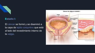 Estadio I:
El cáncer se formó y se diseminó a
la capa de tejido conjuntivo que está
al lado del revestimiento interno de
la vejiga.
 