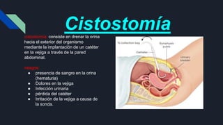 Cistostomía
cistostomía: consiste en drenar la orina
hacia el exterior del organismo
mediante la implantación de un catéter
en la vejiga a través de la pared
abdominal.
riesgos:
● presencia de sangre en la orina
(hematuria)
● Dolores en la vejiga
● Infección urinaria
● pérdida del catéter
● Irritación de la vejiga a causa de
la sonda.
 