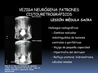 Hiperreflexia del detrusor: lesión conocidaVejiga inestable: ausencia lesión neurológica Imagen de uso libre