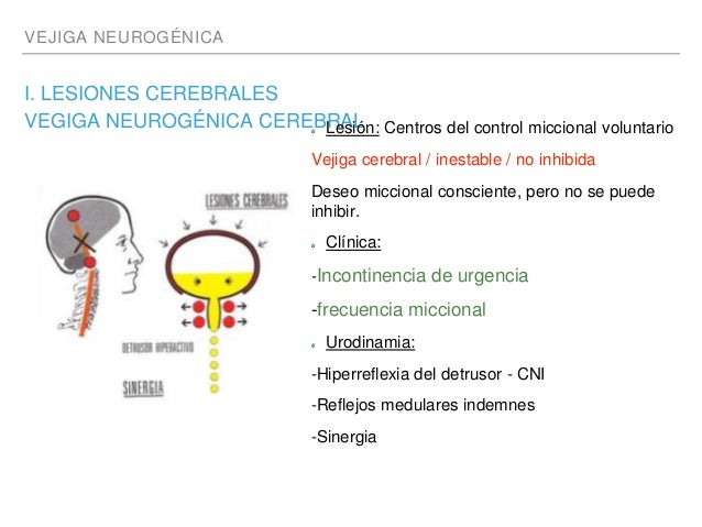 Vejiga neurogenica Vejiga neurogenica