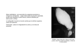 Datos radiológicos : son esenciales los urogramas excretores y
cistogramas retrógrados . vejiga trabeculada de pequeña cap...