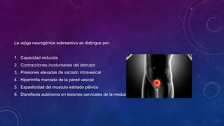 La vejiga neurogénica sobreactiva se distingue por:
1. Capacidad reducida
2. Contracciones involuntarias del detrusor
3. Presiones elevadas de vaciado intravesical
4. Hipertrofia marcada de la pared vesical
5. Espasticidad del musculo estriado pélvico
6. Disreflexia autónoma en lesiones cervicales de la medula.
 