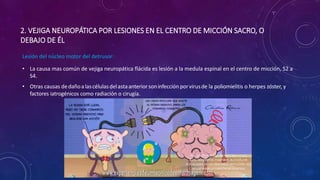 2. VEJIGA NEUROPÁTICA POR LESIONES EN EL CENTRO DE MICCIÓN SACRO, O
DEBAJO DE ÉL
• La causa mas común de vejiga neuropática flácida es lesión a la medula espinal en el centro de micción, S2 a
S4.
• Otras causas dedañoalascélulasdelastaanteriorsoninfección porvirusde la poliomielitis o herpes zóster, y
factores iatrogénicos como radiación o cirugía.
Lesión del núcleo motor del detrusor:
 